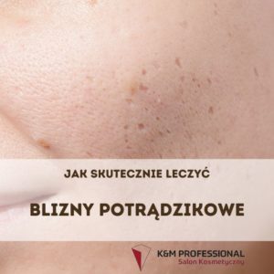 Jak leczyć blizny potrądzikowe
